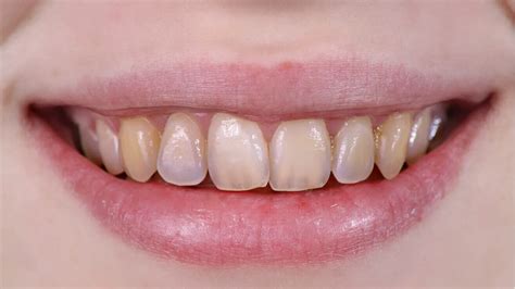 Tooth Discoloration Causes Symptoms Diagnosis And Treatment