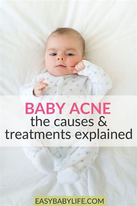 How To Get Rid Of Baby Acne What All Parents Should Know Baby Acne