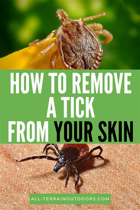 How To Remove An Embedded Tick Head In Human Beings In 2020 Ticks On