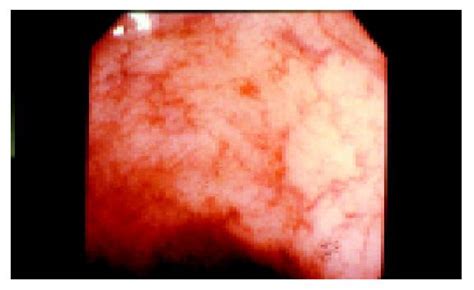 Portal Hypertensive Colopathy In Patients With Liver Cirrhosis
