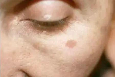 Brown Spots On Skin Causes