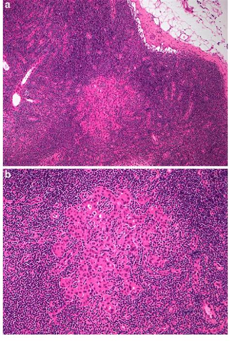 Micrometastasis Within A Sentinel Lymph Node Haematoxylin And Eosin