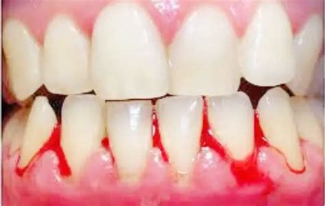 Gum Bleeding Around One Tooth When Flossing Heres What To Do