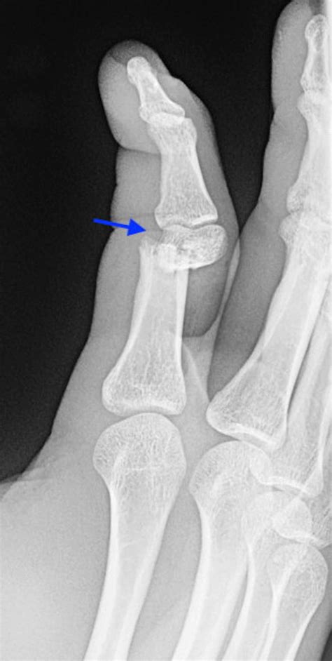 Cureus Phalangeal Fracture Secondary To Hammering Ones Finger