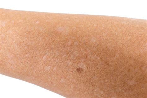 Which Vitamin Deficiency Causes White Spots On Skin The Derm