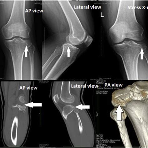Left Knee Type Iii Lateral Tibial Plateau Fracture On Anteroposterior