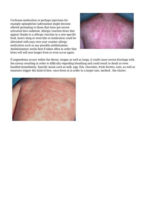 The Recommended Method For Treating Your Cholinergic Urticaria Would
