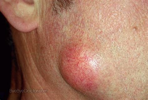 Epidermoid Cysts Pictures Photos
