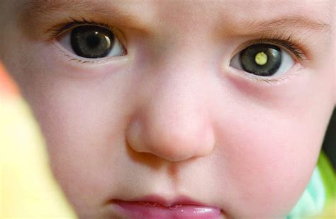 Sintomas Tumor No Olho