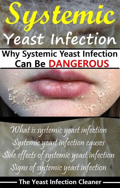 Why Systemic Yeast Infection Can Be Dangerous Yeast Infection