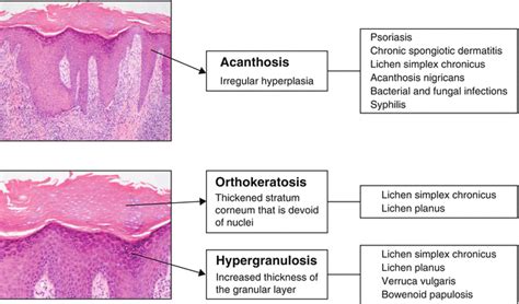 Hyperkeratosis Histology