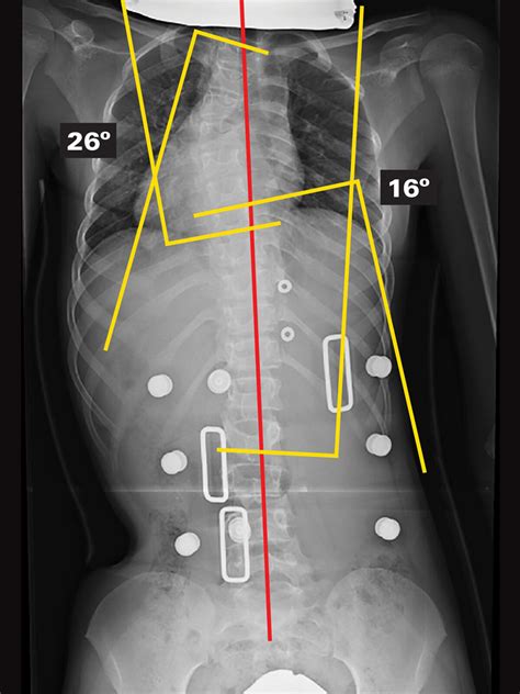 Spinal Technology The Providence Nocturnal Scoliosis System