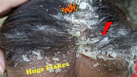 Dandruff Removal Itchy Dry Scalp Huge Flakes Psoriasis Treatment And