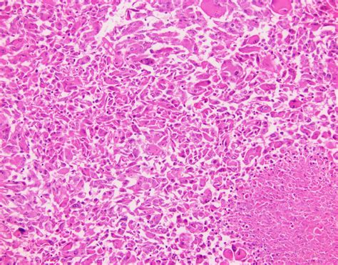 Neuropathology Blog Anaplastic Gangliocytoma In The Frontal Lobe Of A