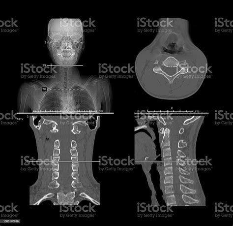 Ct Scan Cervical Spine Anatomy Ct Scan Machine