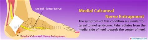 Medial Calcaneal Nerve Entrapmentsymptomstreatment Rest Cold Therapy