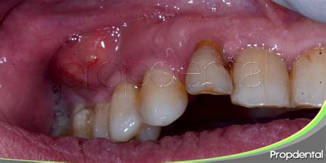 Tipos De Infecciones Dentales ¿como Tratar Una Infección De Boca