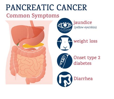 Pancreatic Cancer Symptoms Diagnosis And Its Treatment Cancercuretoday