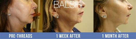 Dr Balshi Delray Beach Silhouette Instalift Before After South