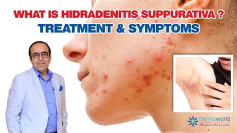 What Is Hidradenitis Suppurativa Treatment And Symptoms Dr Rohit Batra YouTube