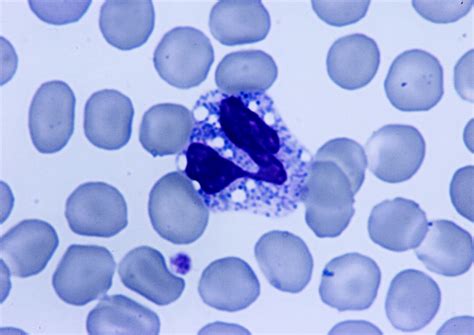 Jordans Anomaly In White Blood Cells Medical Laboratories