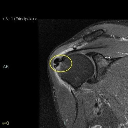 Intraosseous Migration Of Supraspinatus Tendinous Calcification Image