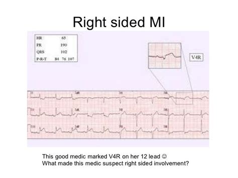 R Sided Ecg Lead Placement Article Blog