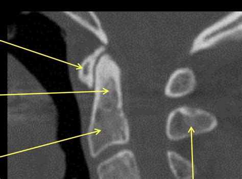 C2 Axis Ct Sagittal Diagram Quizlet