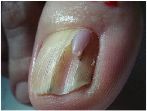 Nail Tumors Clinics In Dermatology
