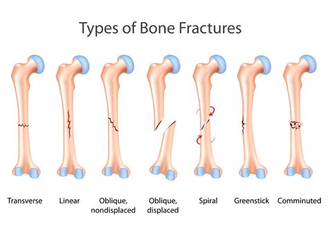 What Is The Difference Between A Fracture And A Broken Bone By Jesse