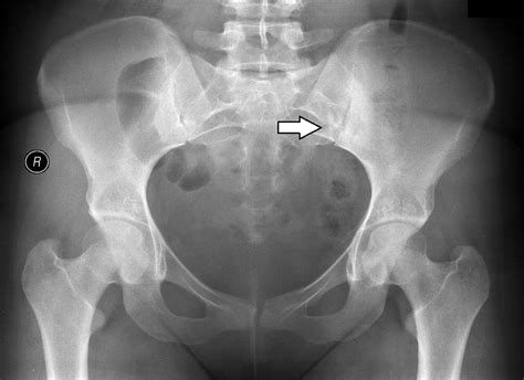 Sacroiliac Joints Radiographic Anatomy Wikiradiography Medical Porn Sex Picture