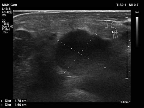 Ultrasonography Of The Lymph Node In The Left Armpit On Admission