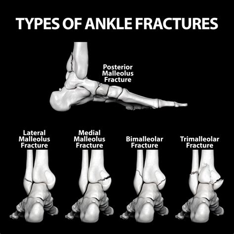 Guide To Bone Fractures Bone Fracture Fractures Fract