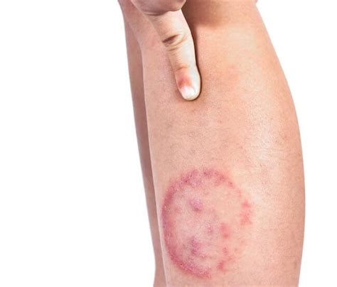 Ringworm Under Fungal Infections Istock 1169313197 Copy 650×555