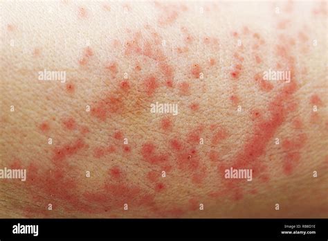 La Dermatitis De Contacto Fotografía De Stock Alamy