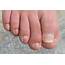 How To Treat A Bruised Or Black Toenail From Running  The Wired Runner