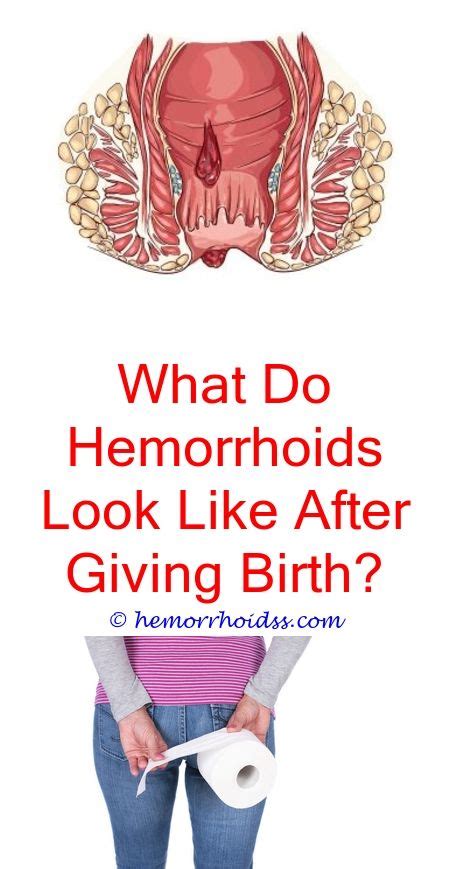 How to treat naturally your hemorrhoids. Pin on Internal Hemorrhoids