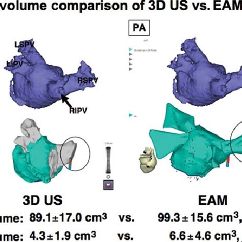 Three Dimensional Ultrasound Electro Anatomic Mapping And Ct Volume