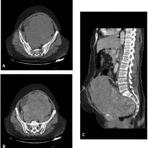 Abdominal Ct Scan Reveal Multiple Well Defined Lobulated Solid Mass In