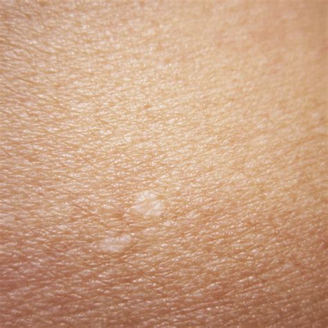 Small white spots on the skin is a condition known as idiopathic guttate hypomelanosis. How to Get Rid of White Spots - How To Get Rid Of Stuff