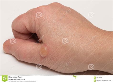 Blister Stock Photo Image Of Person Boil Close Body 38718078