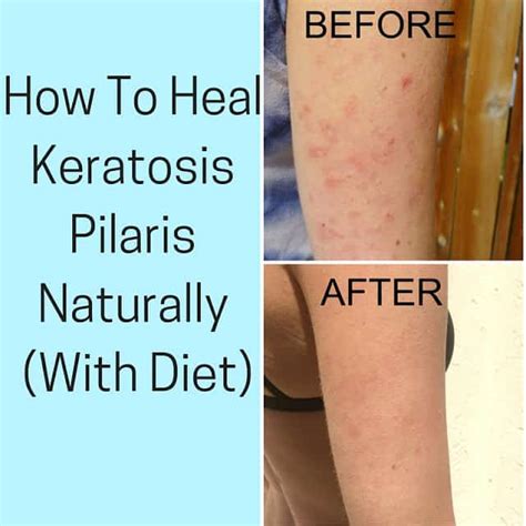 How To Heal Keratosis Pilaris With Diet Pure And Simple Nourishment