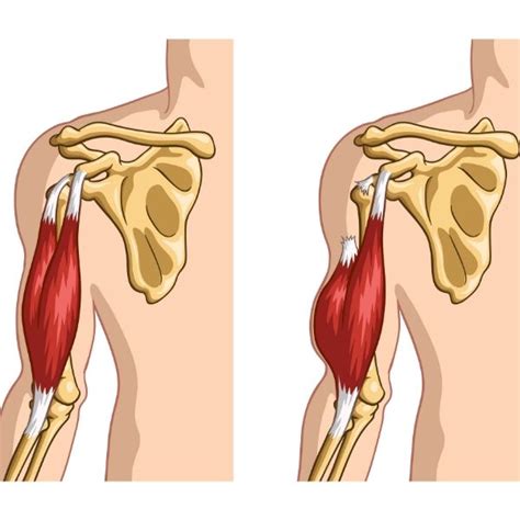 Biceps Tendon Tear And Injury Shoulder Specialist South Windsor Enfield Glastonbury CT