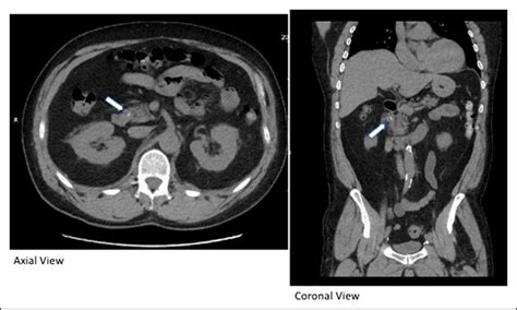 Abdominal Computed Tomography Showing A 19 Mm Linear Radiodensity