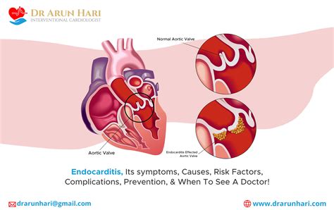 Endocarditis Its Symptoms Causes Risk Factors Complications