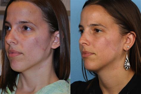 Before And After Pictures Scar Revision Chicago Il Dr Sidle
