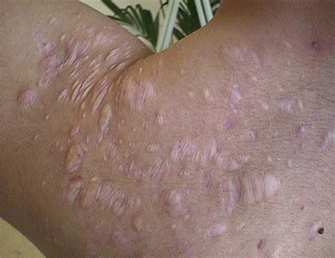 Keloids Hypertrophic Scarring Acne Fulminans Conglobata