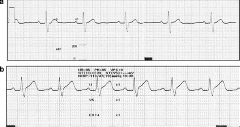 Electrocardiographic Changes After Cpr A After Cardiopulmonary