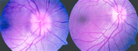 A Right Eye Fundus Photographs Showing Papilledema At Presentation