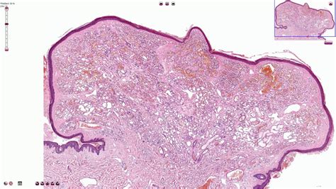 Capillary Hemangioma Histology